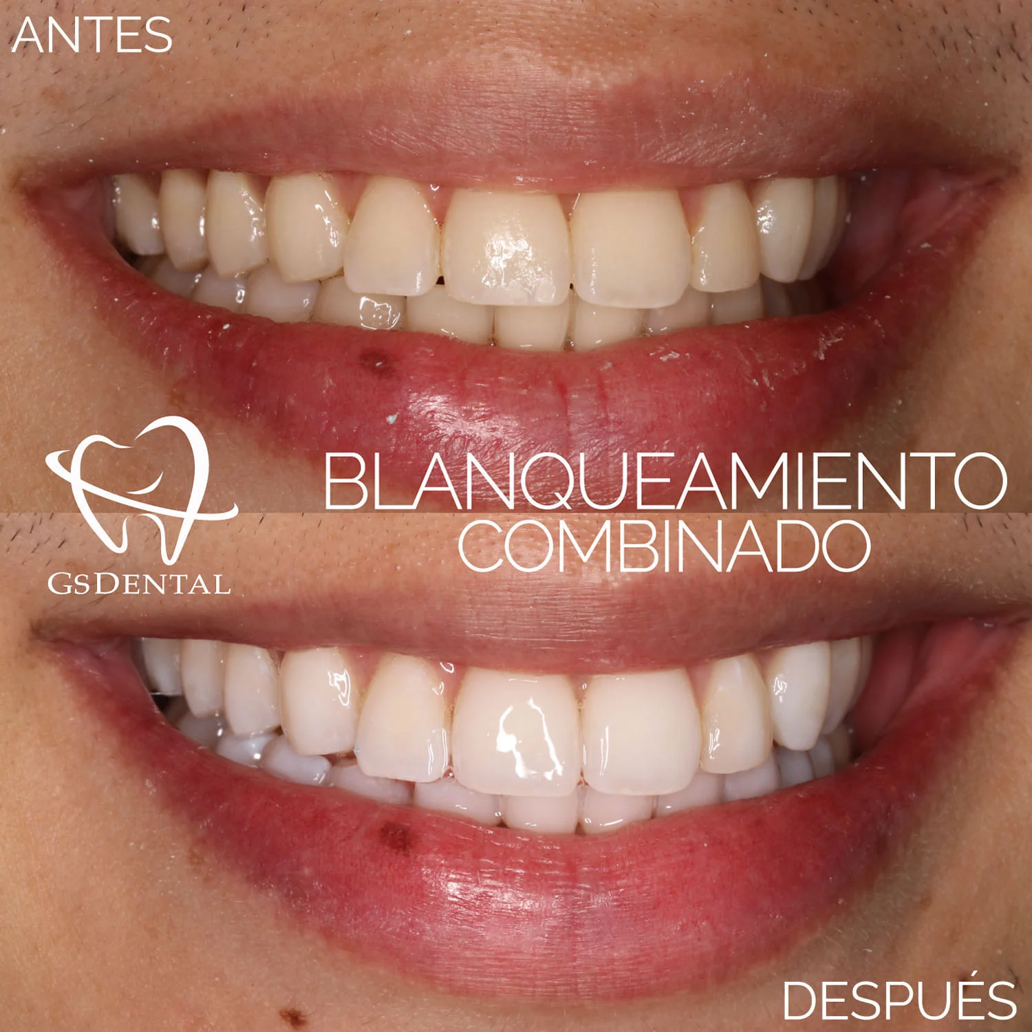 Blanqueamiento